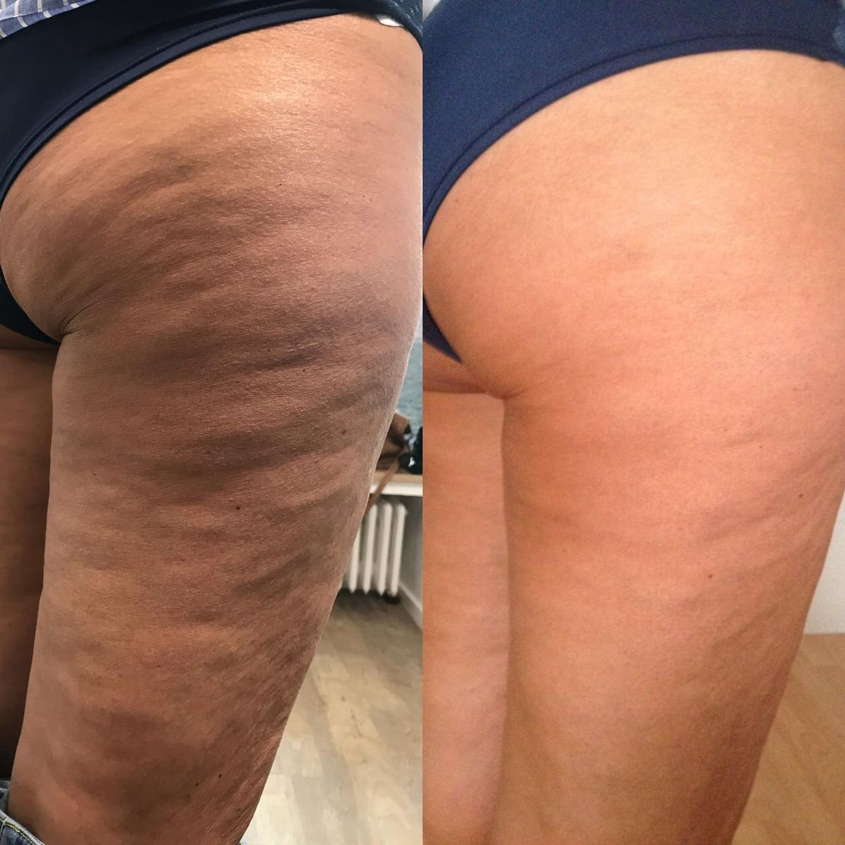 Slätare lår och fastare hud: Så lyckas du minska celluliter hemma